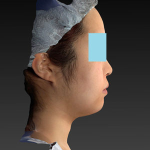 新宿ラクル美容外科クリニック　山本厚志　「ライポライフ脂肪吸引（ジョールファット+あご下）」　手術後１ヶ月目　４月２３日