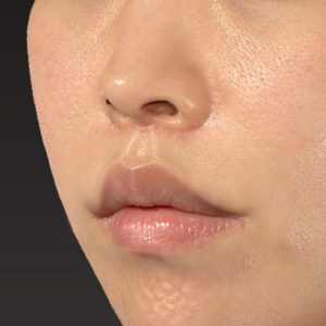 新宿ラクル美容外科クリニック　山本厚志　「人中短縮術（リップリフト）＋口角挙上（スマイルリップ）」　手術後３ヶ月目　４月２９日