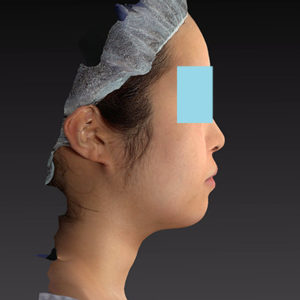 新宿ラクル美容外科クリニック　山本厚志　「ライポライフ脂肪吸引（ジョールファット+あご下）」　手術後３ヶ月目　５月２４日