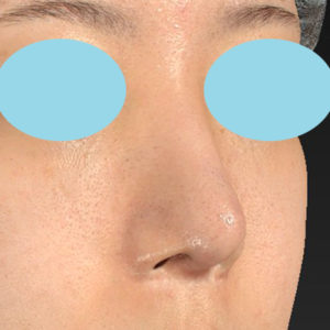 「鼻中隔延長＋耳介軟骨移植＋鼻尖形成＋猫手術＋貴族手術＋鼻骨骨切り幅寄せ」　新宿ラクル美容外科クリニック　２０代女性　手術後６ヶ月目　４月３０日