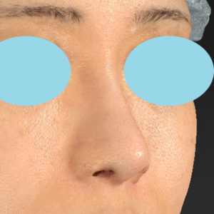 新宿ラクル美容外科クリニック　山本厚志　「小鼻縮小+α法 ＋ 鼻孔縁下降術」　手術後６ヶ月目　６月２７日