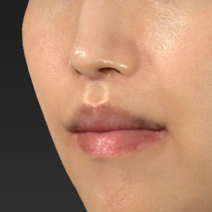 新宿ラクル美容外科クリニック　山本厚志　「人中短縮術（リップリフト）＋口角挙上（スマイルリップ）」　手術後６ヶ月目　７月２１日