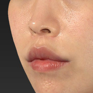 新宿ラクル美容外科クリニック　山本厚志　「人中短縮術（リップリフト）＋口角挙上（スマイルリップ）」　手術後６ヶ月目　８月１０日