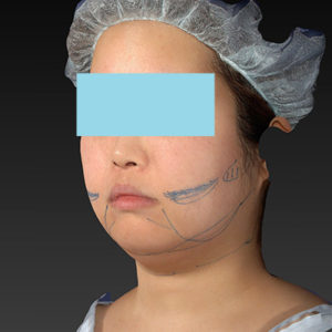 新宿ラクル美容外科クリニック　山本厚志　「ライポライフ脂肪吸引（ジョールファット+あご下）」　デザイン　４月２３日