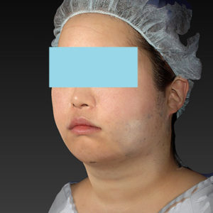 新宿ラクル美容外科クリニック　山本厚志　「ライポライフ脂肪吸引（ジョールファット+あご下）」　手術直後　４月２３日