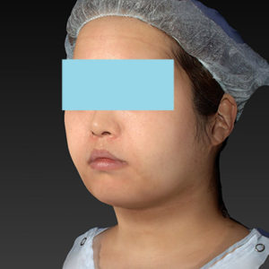 新宿ラクル美容外科クリニック　山本厚志　「ライポライフ脂肪吸引（ジョールファット+あご下）」　手術後１週間目　４月２３日