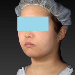 新宿ラクル美容外科クリニック　山本厚志　「ライポライフ脂肪吸引（ジョールファット+あご下）」　手術後１ヶ月目　４月２３日