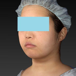 新宿ラクル美容外科クリニック　山本厚志　「ライポライフ脂肪吸引（ジョールファット+あご下）」　手術後２ヶ月目　４月２３日