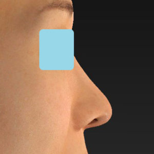 「鼻中隔延長（鼻中隔軟骨）＋耳介軟骨移植＋鼻尖形成＋真皮脂肪移植（鼻尖）＋猫手術」　新宿ラクル美容外科クリニック　３０代女性　手術後３ヶ月目　５月２０日