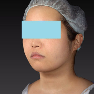 新宿ラクル美容外科クリニック　山本厚志　「ライポライフ脂肪吸引（ジョールファット+あご下）」　手術後３ヶ月目　５月２４日