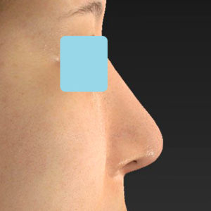 「鼻中隔延長＋耳介軟骨移植＋鼻尖形成＋猫手術＋貴族手術＋鼻骨骨切り幅寄せ」　新宿ラクル美容外科クリニック　２０代女性　手術後６ヶ月目　４月３０日