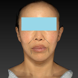 新宿ラクル美容外科クリニック　山本厚志　ナチュラルフェイスネックリフト　デザイン　６月７日