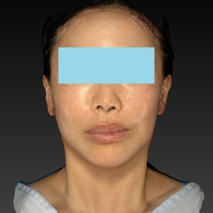 新宿ラクル美容外科クリニック　山本厚志　ナチュラルフェイスネックリフト　手術直後　６月７日