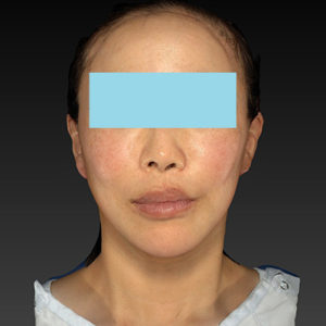 新宿ラクル美容外科クリニック　山本厚志　ナチュラルフェイスネックリフト　手術後１週間目　６月７日