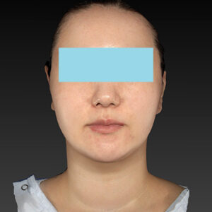 新宿ラクル美容外科クリニック　山本厚志　「ナチュラルフェイスネックリフト」「ライポライフ脂肪吸引（ジョールファット+あご下）」　手術後１２ヶ月目　１０月３１日