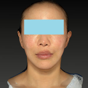 新宿ラクル美容外科クリニック　山本厚志　ナチュラルフェイスネックリフト　手術後１ヶ月目　６月７日