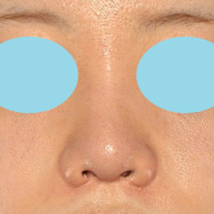 新宿ラクル美容外科クリニック　山本厚志　「貴族手術（鼻翼基部プロテーゼ）＋ 小鼻縮小+α法＋鼻プロテーゼ隆鼻術」　手術後３ヶ月目　５月２１日