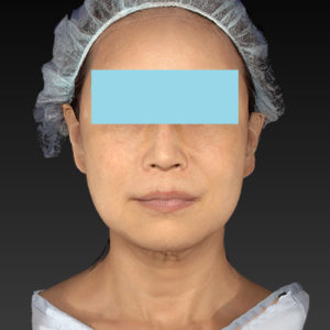 新宿ラクル美容外科クリニック　山本厚志　「アルテミスリフト」　手術後３ヶ月目　７月８日