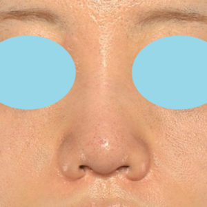 新宿ラクル美容外科クリニック　山本厚志　「貴族手術（鼻翼基部プロテーゼ）＋ 小鼻縮小+α法＋鼻プロテーゼ隆鼻術」　手術後６ヶ月目　８月３日