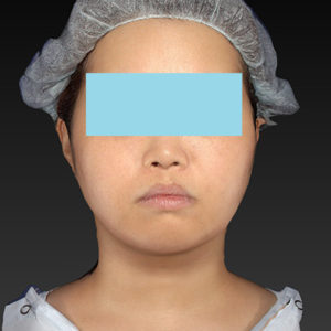 新宿ラクル美容外科クリニック　山本厚志　「ライポライフ脂肪吸引（ジョールファット+あご下）」　手術後６ヶ月目　８月１８日