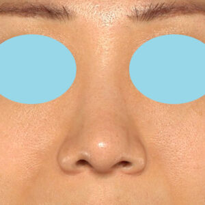 「鼻中隔延長（鼻中隔軟骨）＋耳介軟骨移植＋鼻尖形成＋真皮脂肪移植（鼻尖）＋猫手術」　新宿ラクル美容外科クリニック　３０代女性　手術後６ヶ月目　１２月１６日