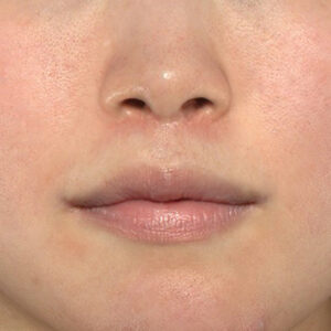 新宿ラクル美容外科クリニック　山本厚志　「人中短縮術（リップリフト）＋口角挙上（スマイルリップ）」　手術後６ヶ月目　１月２日