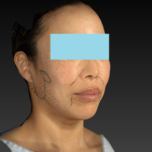 新宿ラクル美容外科クリニック　山本厚志　ナチュラルフェイスネックリフト　デザイン　６月７日