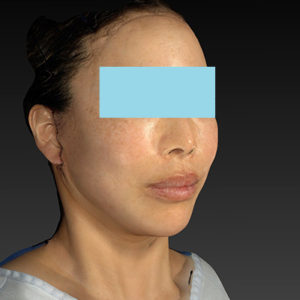 新宿ラクル美容外科クリニック　山本厚志　ナチュラルフェイスネックリフト　手術直後　６月７日