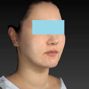 新宿ラクル美容外科クリニック　山本厚志　「ナチュラルフェイスネックリフト」「ライポライフ脂肪吸引（ジョールファット+あご下）」　手術後１２ヶ月目　１０月３１日