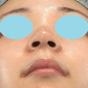 新宿ラクル美容外科クリニック　山本厚志　「小鼻縮小+α法」　手術後１２ヶ月目　１２月２日