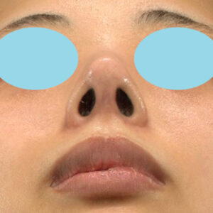 「鼻中隔延長＋耳介軟骨移植＋鼻尖形成＋ワシ鼻修正（ハンプ切除）」　新宿ラクル美容外科クリニック　２０代女性　手術後１２ヶ月目　１２月２４日