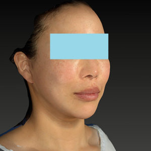 新宿ラクル美容外科クリニック　山本厚志　ナチュラルフェイスネックリフト　手術後１ヶ月目　６月７日