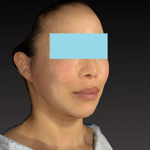 新宿ラクル美容外科クリニック　山本厚志　ナチュラルフェイスネックリフト　手術後２ヶ月目　６月７日