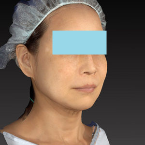 新宿ラクル美容外科クリニック　山本厚志　「アルテミスリフト」　手術後３ヶ月目　７月８日