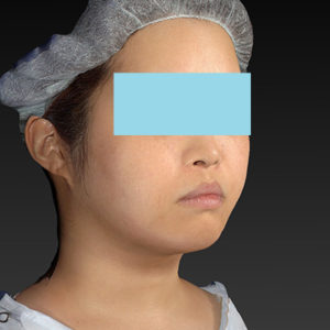 新宿ラクル美容外科クリニック　山本厚志　「ライポライフ脂肪吸引（ジョールファット+あご下）」　手術後６ヶ月目　８月１８日