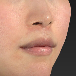 新宿ラクル美容外科クリニック　山本厚志　「人中短縮術（リップリフト）＋口角挙上（スマイルリップ）」　手術後６ヶ月目　１月２日