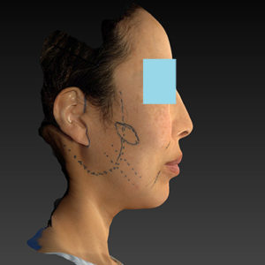 新宿ラクル美容外科クリニック　山本厚志　ナチュラルフェイスネックリフト　デザイン　６月７日