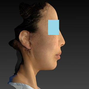 新宿ラクル美容外科クリニック　山本厚志　ナチュラルフェイスネックリフト　手術直後　６月７日