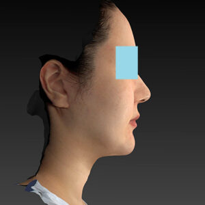 新宿ラクル美容外科クリニック　山本厚志　「ナチュラルフェイスネックリフト」「ライポライフ脂肪吸引（ジョールファット+あご下）」　手術後１２ヶ月目　１０月３１日