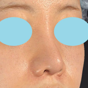 新宿ラクル美容外科クリニック　山本厚志　「貴族手術（鼻翼基部プロテーゼ）＋ 小鼻縮小+α法＋鼻プロテーゼ隆鼻術」　手術後３ヶ月目　５月２１日