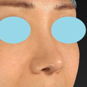 「鼻中隔延長（鼻中隔軟骨）＋耳介軟骨移植＋鼻尖形成＋真皮脂肪移植（鼻尖）＋猫手術」　新宿ラクル美容外科クリニック　３０代女性　手術後６ヶ月目　１２月１６日