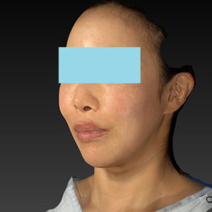 新宿ラクル美容外科クリニック　山本厚志　ナチュラルフェイスネックリフト　手術前　６月８日