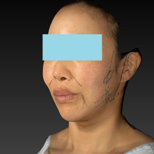 新宿ラクル美容外科クリニック　山本厚志　ナチュラルフェイスネックリフト　デザイン　６月７日