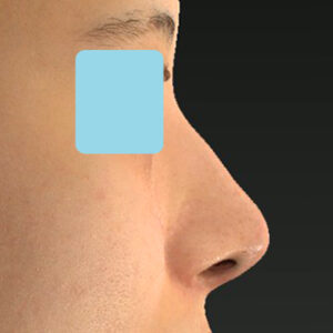 「鼻中隔延長＋耳介軟骨移植＋鼻尖形成＋ワシ鼻修正（ハンプ切除）」　新宿ラクル美容外科クリニック　２０代女性　手術後１２ヶ月目　１２月２４日