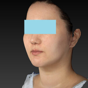 新宿ラクル美容外科クリニック　山本厚志　「ナチュラルフェイスネックリフト」「ライポライフ脂肪吸引（ジョールファット+あご下）」　手術後１２ヶ月目　１０月３１日