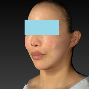 新宿ラクル美容外科クリニック　山本厚志　ナチュラルフェイスネックリフト　手術後１ヶ月目　６月７日