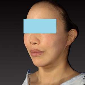 新宿ラクル美容外科クリニック　山本厚志　ナチュラルフェイスネックリフト　手術後２ヶ月目　６月７日