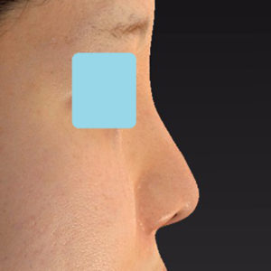 新宿ラクル美容外科クリニック　山本厚志　「貴族手術（鼻翼基部プロテーゼ）＋ 小鼻縮小+α法＋鼻プロテーゼ隆鼻術」　手術後３ヶ月目　５月２１日