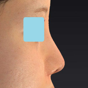 新宿ラクル美容外科クリニック　山本厚志　「貴族手術（鼻翼基部プロテーゼ）＋ 小鼻縮小+α法＋鼻プロテーゼ隆鼻術」　手術後６ヶ月目　８月３日