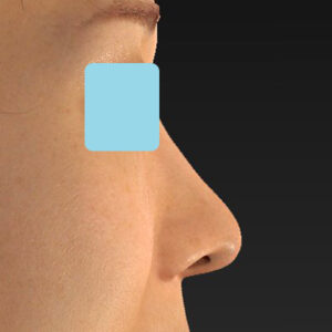 「鼻中隔延長（鼻中隔軟骨）＋耳介軟骨移植＋鼻尖形成＋真皮脂肪移植（鼻尖）＋猫手術」　新宿ラクル美容外科クリニック　３０代女性　手術後６ヶ月目　１２月１６日